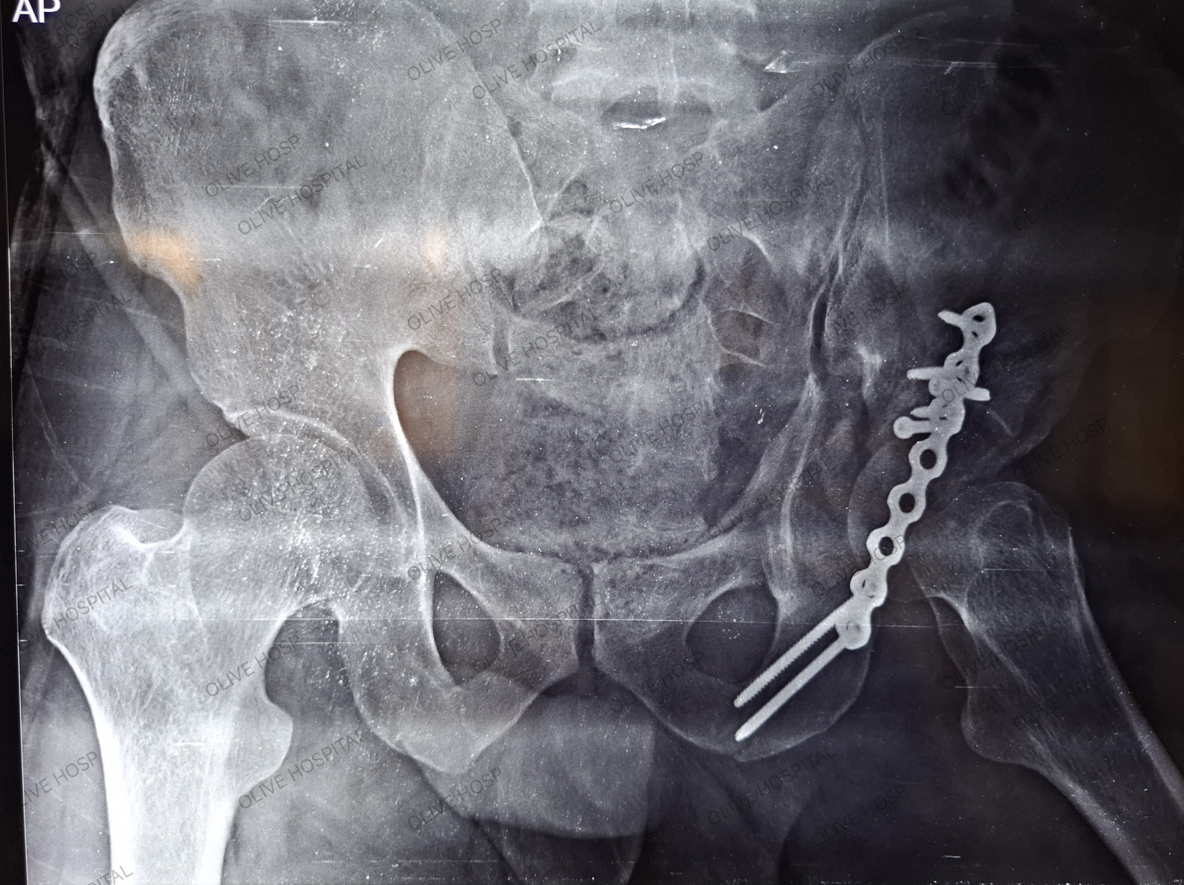 orthopaedic doctor in Patna